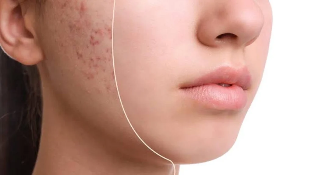 Pilih Skincare Tepat untuk Kulit Berjerawat